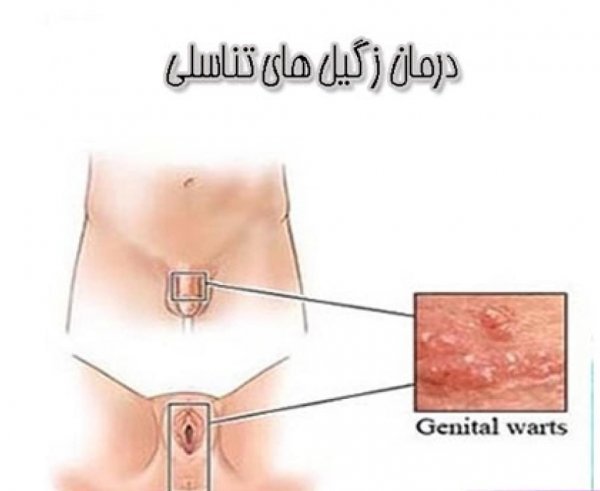 درمان زگیل تناسلی در زنان چقدر طول میکشد؟
