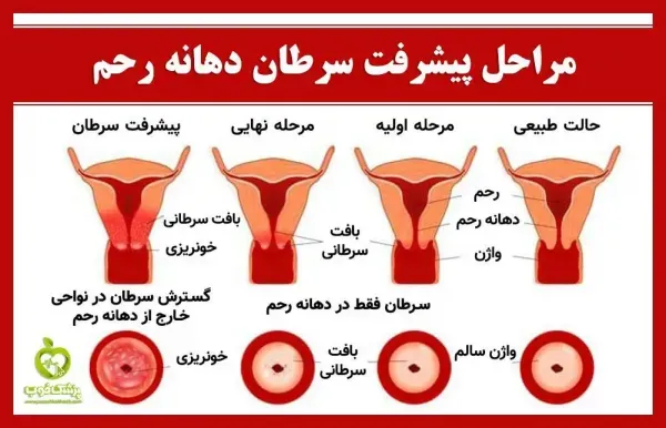  درمان زگیل تناسلی در زنان چقدر طول میکشد؟