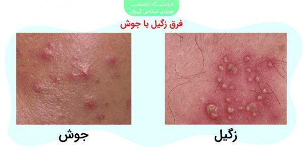  درمان زگیل تناسلی در زنان چقدر طول میکشد؟