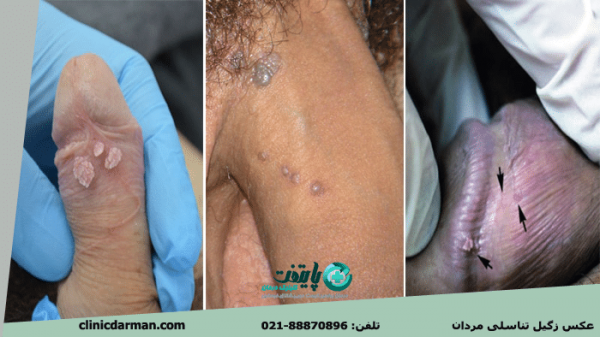 بهترین دارو برای از بین بردن زگیل تناسلی مردان