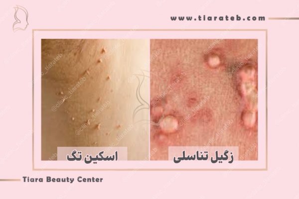  بهترین دارو برای از بین بردن زگیل تناسلی مردان