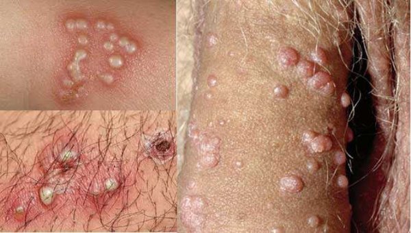  بهترین دارو برای از بین بردن زگیل تناسلی مردان