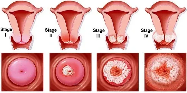  بهترین دارو برای از بین بردن زگیل تناسلی مردان