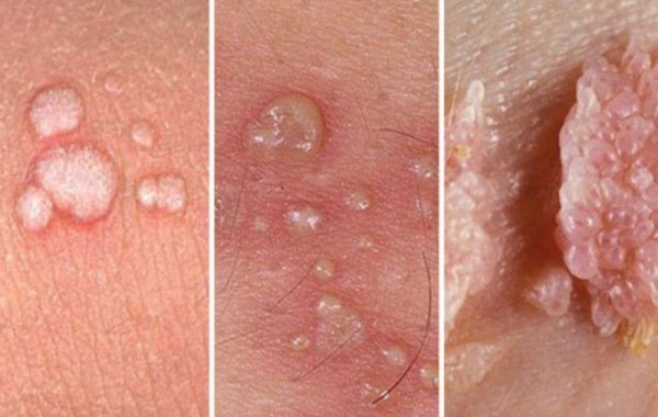  آیا اچ پی وی HPV از طریق بوسه منتقل می شود؟