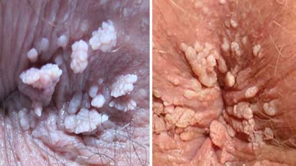  آیا زگیل مقعدی خطرناک است/عکس و علائم زگیل مقعدی