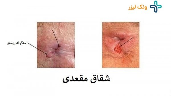  آیا زگیل مقعدی خطرناک است/عکس و علائم زگیل مقعدی