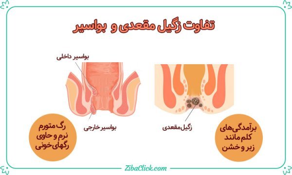  آیا زگیل مقعدی خطرناک است/عکس و علائم زگیل مقعدی
