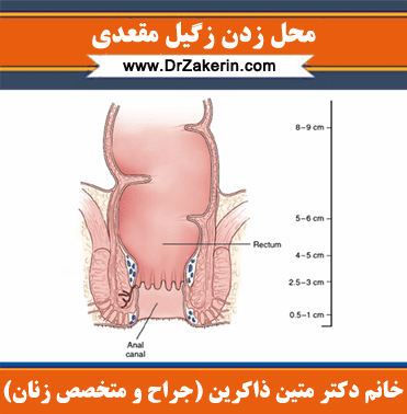  آیا زگیل مقعدی خطرناک است/عکس و علائم زگیل مقعدی