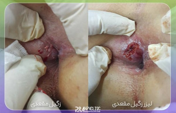  آیا زگیل مقعدی خطرناک است/عکس و علائم زگیل مقعدی