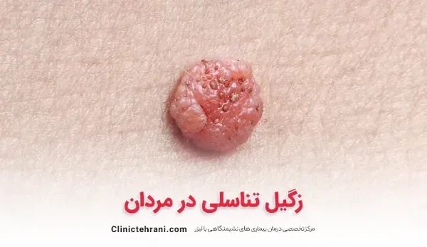  آیا زگیل مقعدی خطرناک است/عکس و علائم زگیل مقعدی