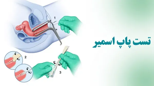 از چه سنی باید تست پاپ اسمیر انجام داد؟