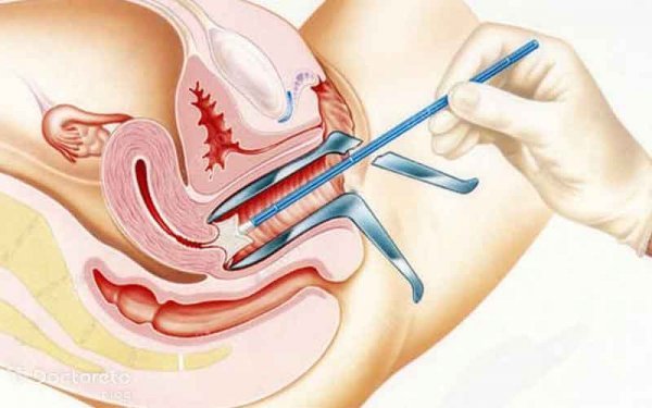  از چه سنی باید تست پاپ اسمیر انجام داد؟
