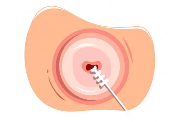  از چه سنی باید تست پاپ اسمیر انجام داد؟