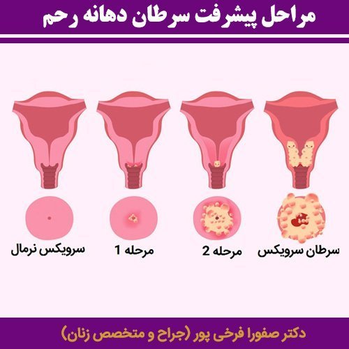 اگر نتیجه / جواب کولپوسکوپی مثبت باشد چه میشود؟