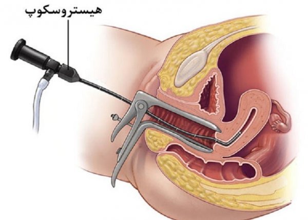 هیستروسکوپی برای چی انجام میشه؟