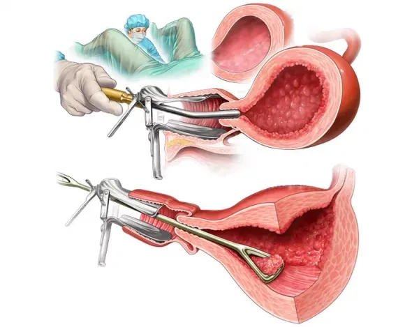  هیستروسکوپی برای چی انجام میشه؟