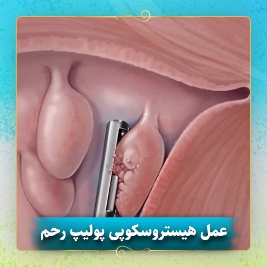  هیستروسکوپی برای چی انجام میشه؟