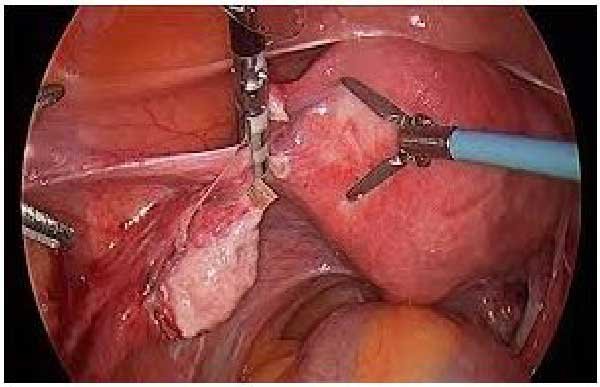  هیستروسکوپی برای چی انجام میشه؟