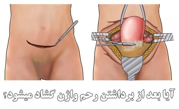 آیا بعد از برداشتن رحم واژن گشاد میشود؟