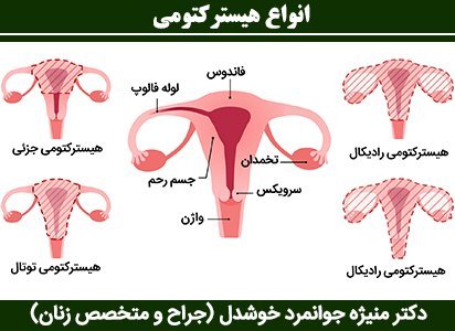  آیا بعد از برداشتن رحم واژن گشاد میشود؟