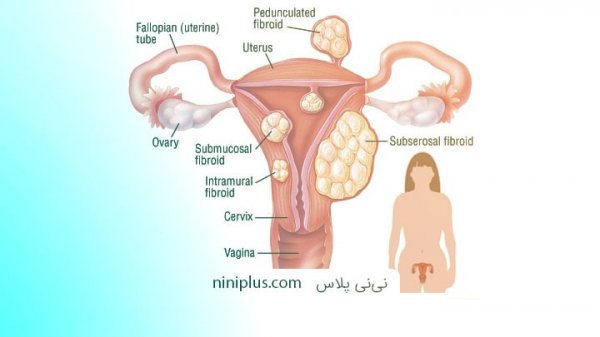  بعد از برداشتن رحم اسپرم کجا میرود/سکس بعد از برداشتن رحم