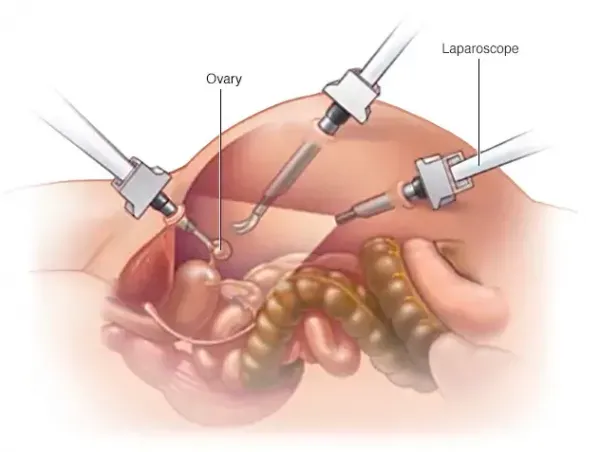  بعد از برداشتن رحم اسپرم کجا میرود/سکس بعد از برداشتن رحم