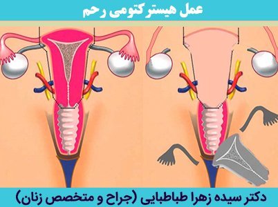  بعد از برداشتن رحم اسپرم کجا میرود/سکس بعد از برداشتن رحم