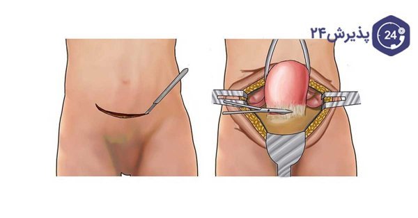  بعد از برداشتن رحم اسپرم کجا میرود/سکس بعد از برداشتن رحم