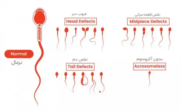 عکس جواب آزمایش اسپرم نرمال/اسپرم قوی/اسپرم ضعیف
