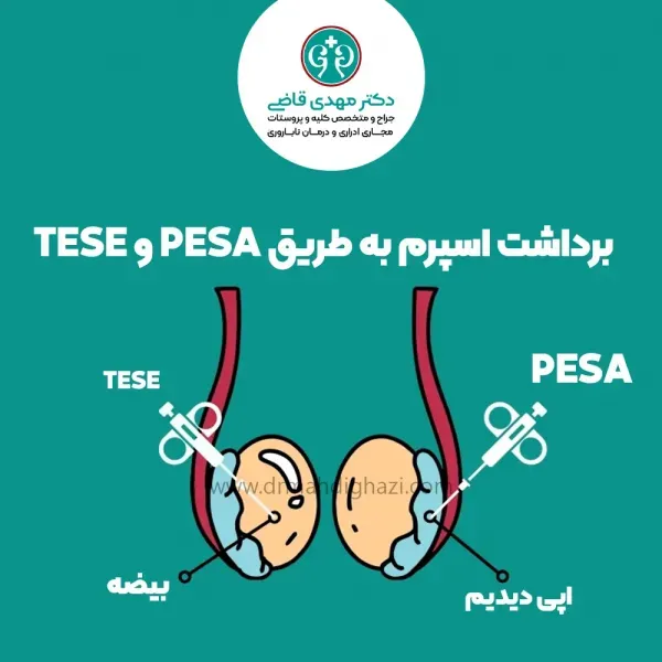  شرایط فریز اسپرم / روش فریز اسپرم / نحوه فریز اسپرم