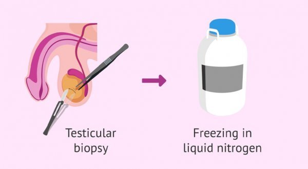  اسپرم فریز شده یعنی چی / هزینه فریز اسپرم 1404