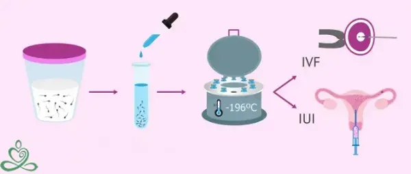  اسپرم فریز شده تا چند سال قابل استفاده است؟