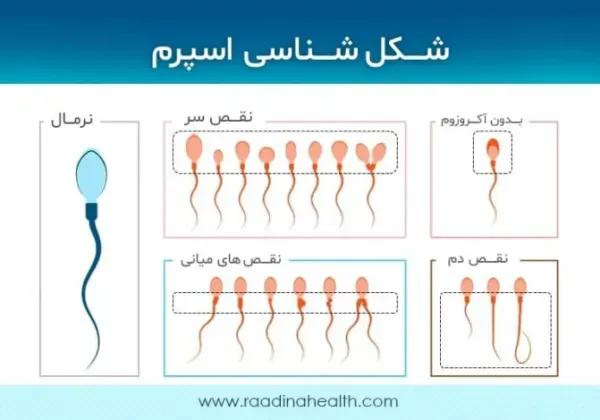  اسپرم فریز شده تا چند سال قابل استفاده است؟