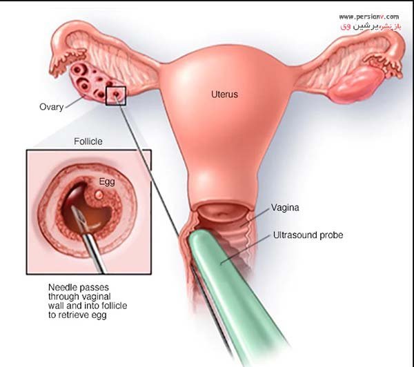  آیا اهدای تخمک باعث نازایی میشود/تجربه زنان پس از اهدای تخمک