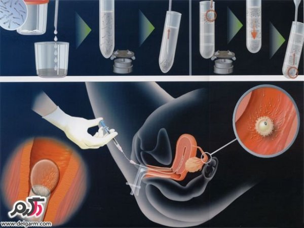 مقایسه کامل بین فریز اسپرم و فریز تخمک