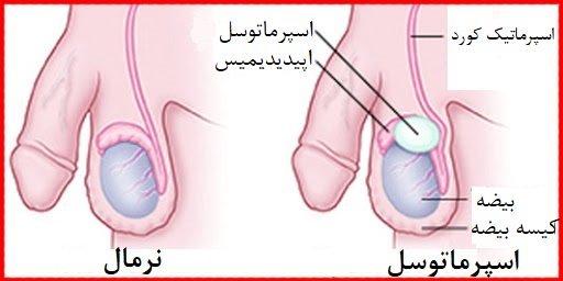  مقایسه کامل بین فریز اسپرم و فریز تخمک