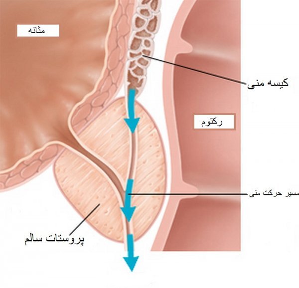  مقایسه کامل بین فریز اسپرم و فریز تخمک