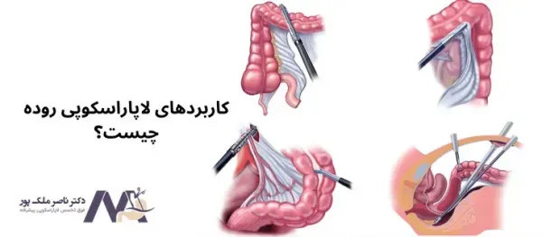 فیلم جراحی لاپاراسکوپی روده بزرگ