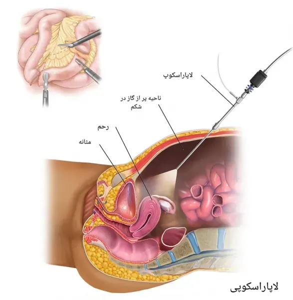  فیلم جراحی لاپاراسکوپی روده بزرگ