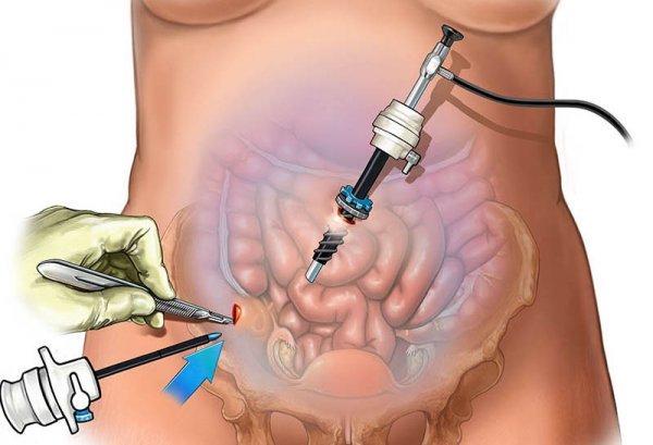  فیلم جراحی لاپاراسکوپی روده بزرگ