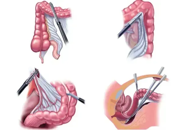  فیلم جراحی لاپاراسکوپی روده بزرگ