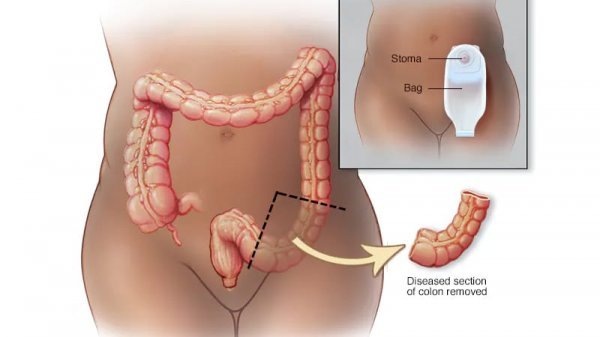جراحی روده به چه صورت است؟
