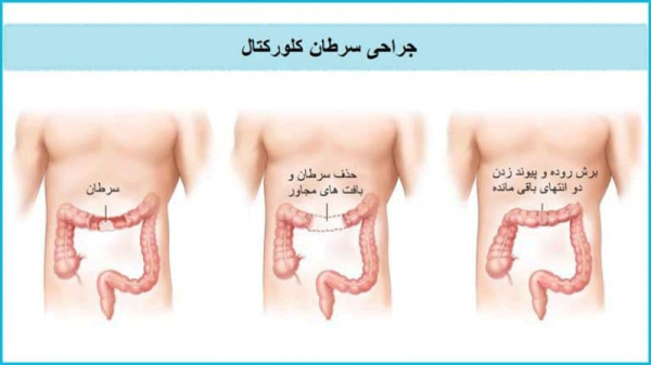  جراحی روده به چه صورت است؟