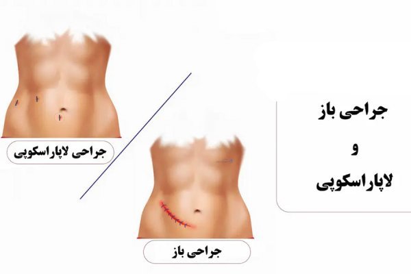  جراحی روده به چه صورت است؟