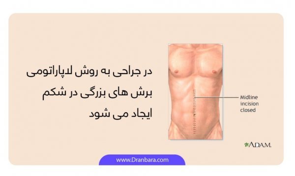  جراحی روده به چه صورت است؟