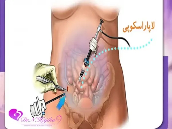  لاپاراسکوپی رحم از واژن