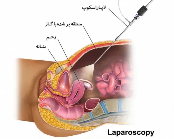  هزینه عمل فیبروم رحم با لیزر