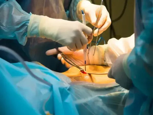  هزینه عمل فیبروم رحم با لیزر