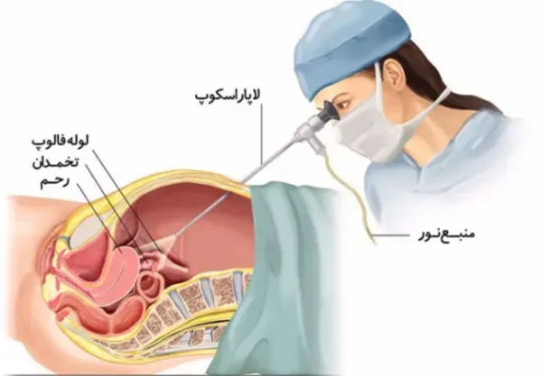  هزینه عمل فیبروم رحم با لیزر