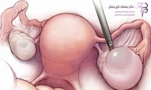  هزینه عمل فیبروم رحم با لیزر